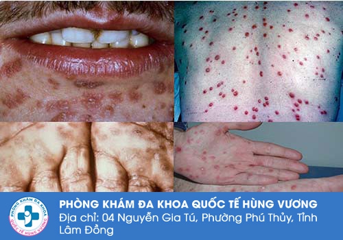Hình ảnh về bệnh giang mai