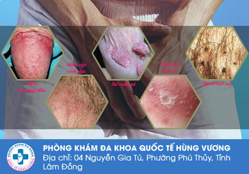 Nguyên nhân bệnh lý dẫn đến bị ngứa vùng kín ở nam giới