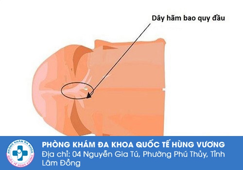 có nên cắt dây hãm bao quy đầu không?