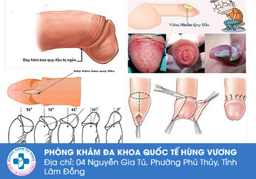 dây hãm bao quy đầu