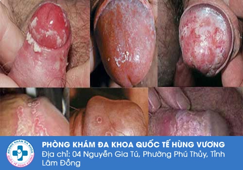 Bựa sinh dục