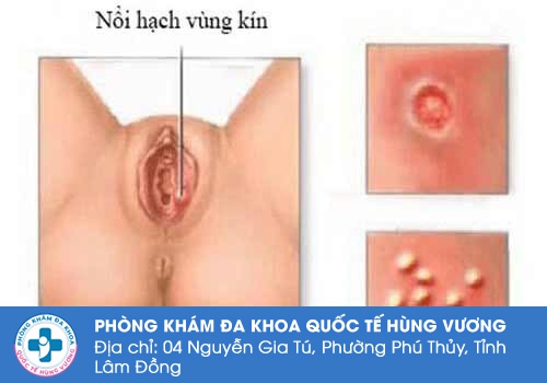 Nổi hạch ở vùng kín nữ