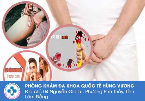 Những tác hại nguy hiểm của việc nổi hạch ở vùng kín