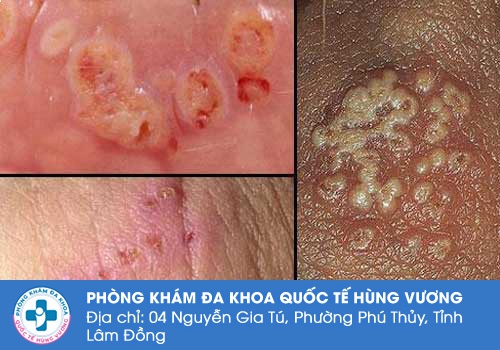 Nổi hạch ở vùng kín nam