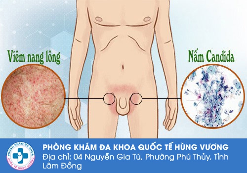Nguyên nhân bệnh lý khiến vùng háng nam giới bị nổi mụn