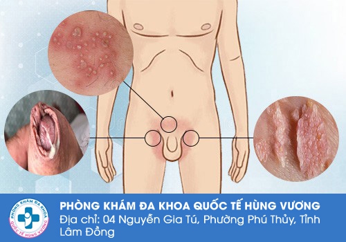 Nổi mụn ở háng cũng không thể thiếu sự