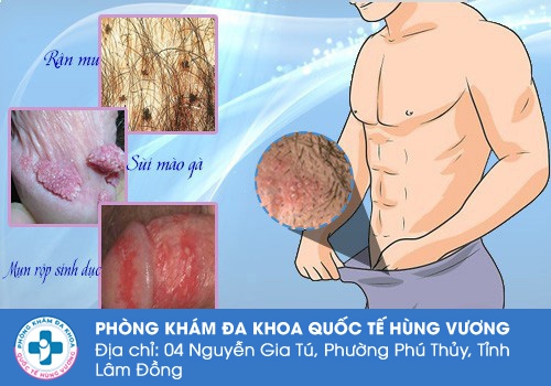 Các nguyên nhân bệnh lý gây nổi mụn ở vùng lông mu nam giới