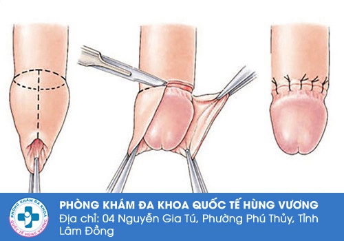 cắt dây hãm bao quy đầu