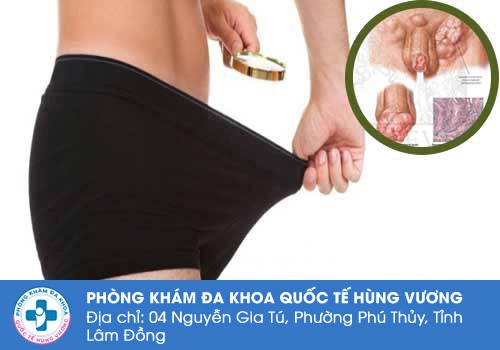 Dương vật nổi hạch là do đâu?