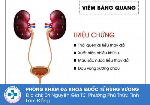 Triệu chứng viêm bàng quang